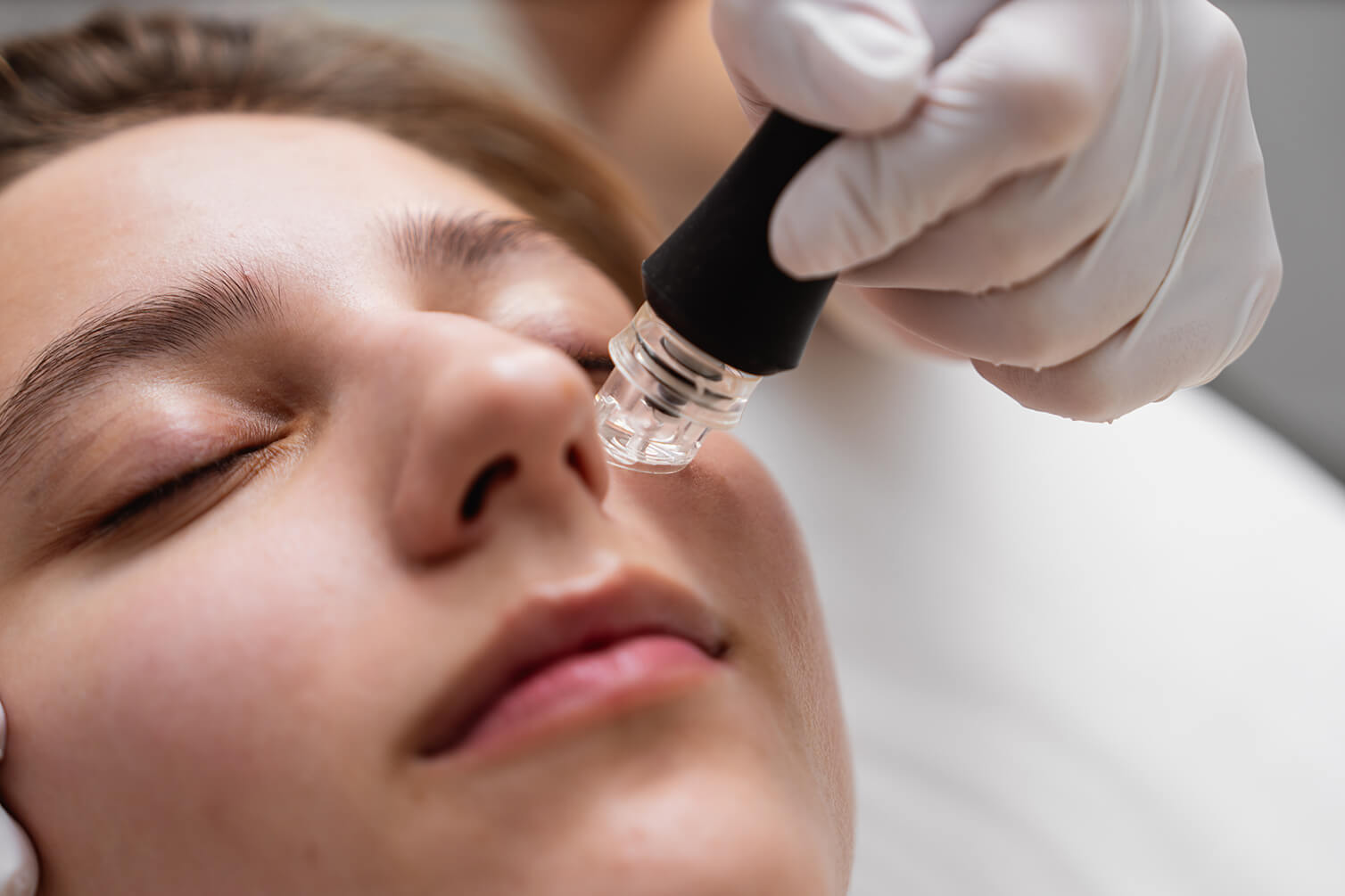 Microneedling Microneedling